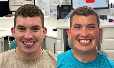 jamie invisalign y bont